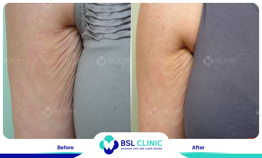 result Skin Tightening Alma TitenFX02