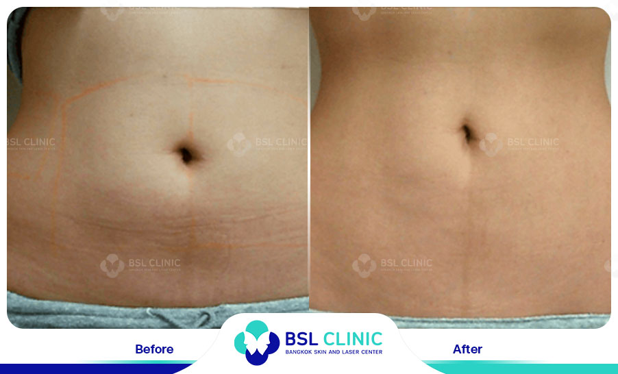 result Skin Tightening Alma TitenFX02