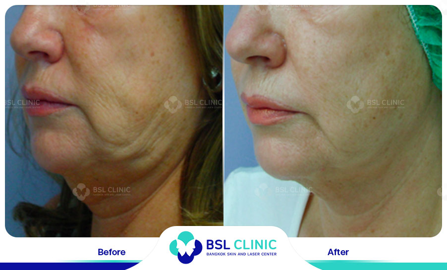 result Skin Tightening Alma TitenFX02