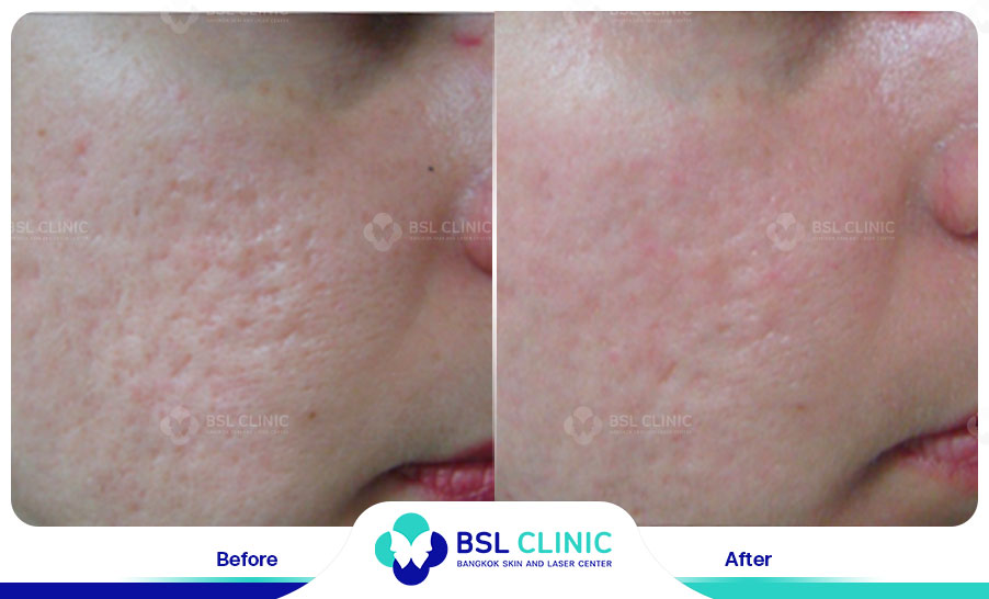 result Skin Tightening Alma TitenFX02