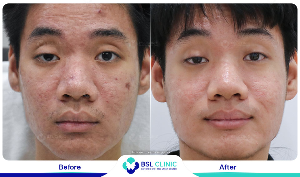 result before after scar