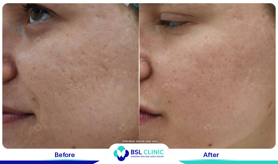 result before after scar
