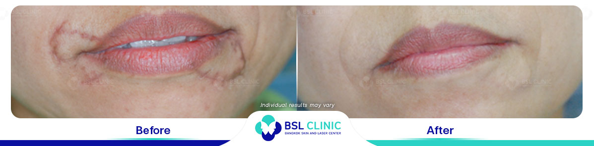 result before after scar