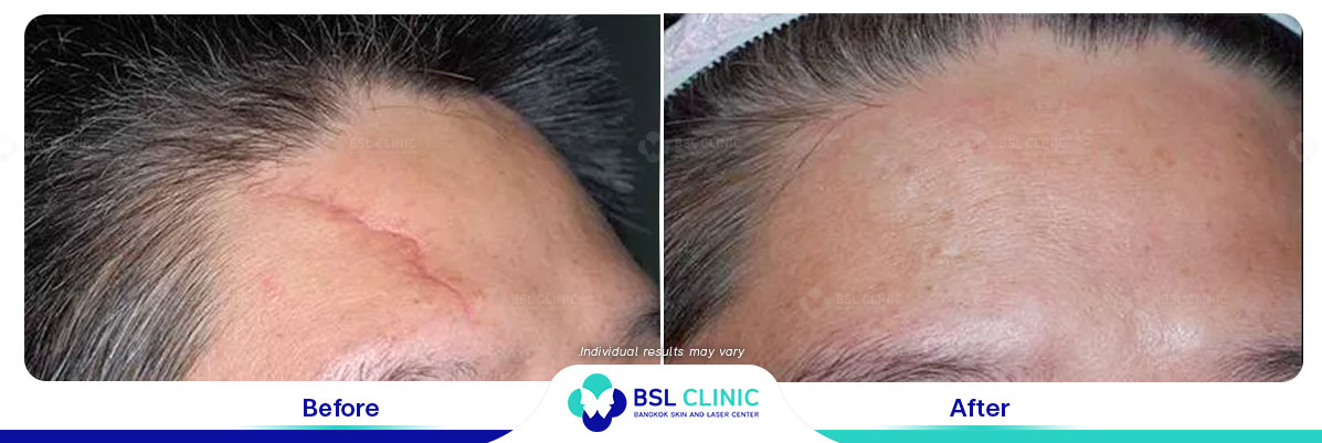 result before after scar