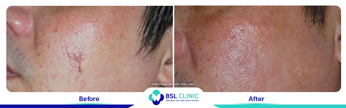 result before after scar
