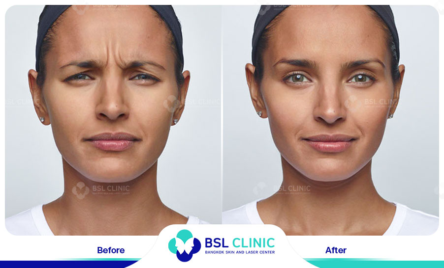 result-aniti-wrinkles--aging