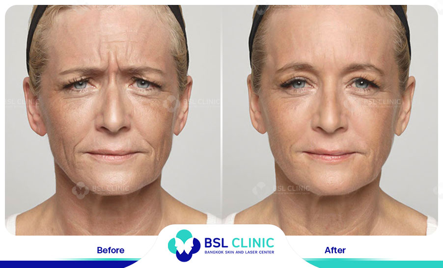 result-aniti-wrinkles--aging