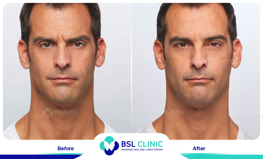 result-aniti-wrinkles--aging