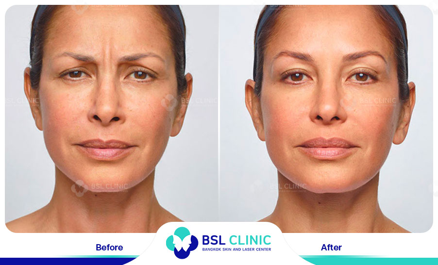 result-aniti-wrinkles--aging