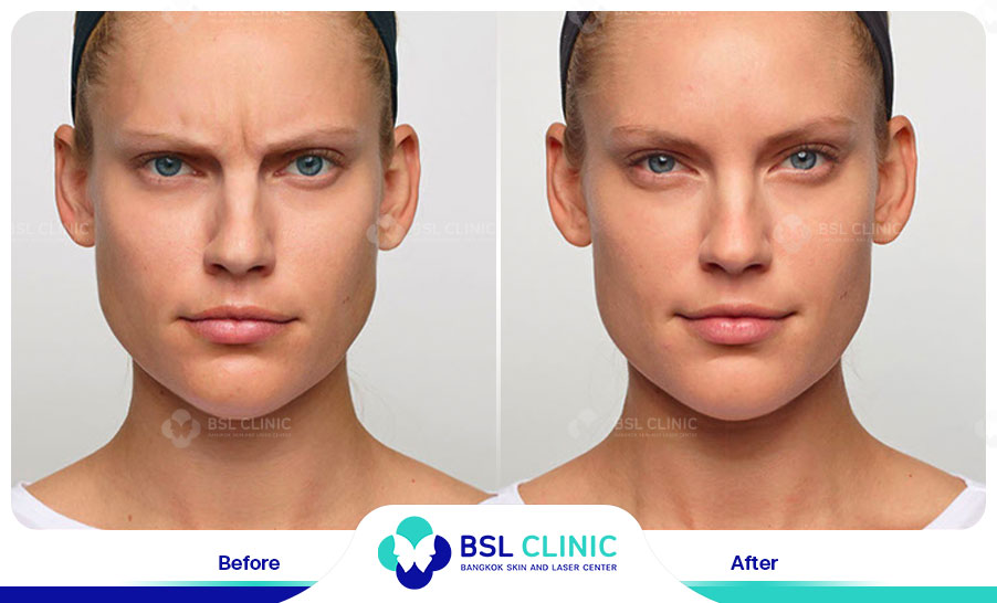 result-aniti-wrinkles--aging