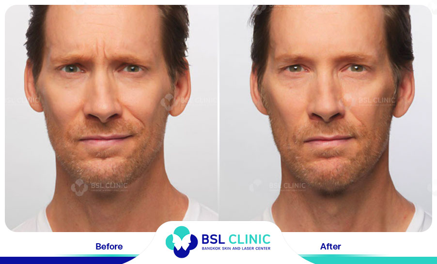 result-aniti-wrinkles--aging