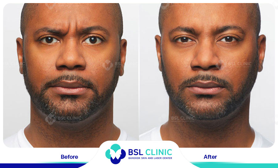 result-aniti-wrinkles--aging