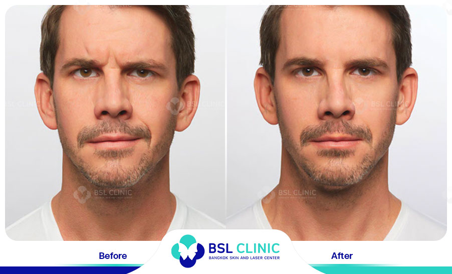 result-aniti-wrinkles--aging