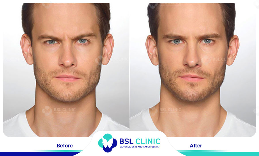 result-aniti-wrinkles--aging