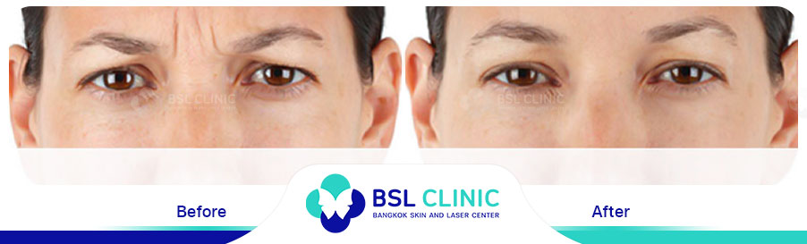 result-aniti-wrinkles-anti-aging