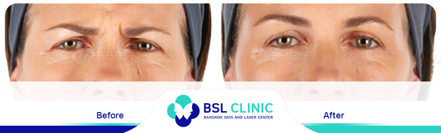 result-aniti-wrinkles-anti-aging