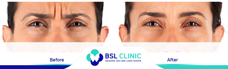 result-aniti-wrinkles-anti-aging