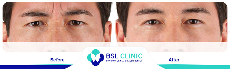result-aniti-wrinkles-anti-aging