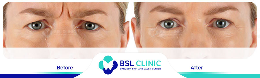 result-aniti-wrinkles-anti-aging
