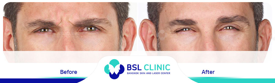 result-aniti-wrinkles-anti-aging
