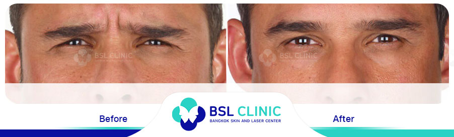 result-aniti-wrinkles-anti-aging