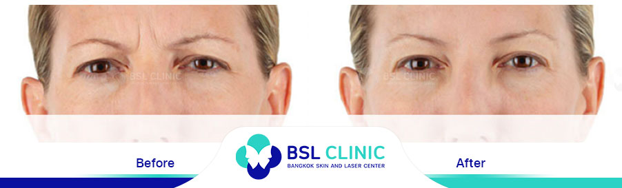 result-aniti-wrinkles-anti-aging