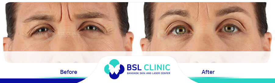 result-aniti-wrinkles-anti-aging