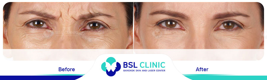 result-aniti-wrinkles-anti-aging