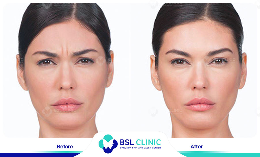 result-aniti-wrinkles