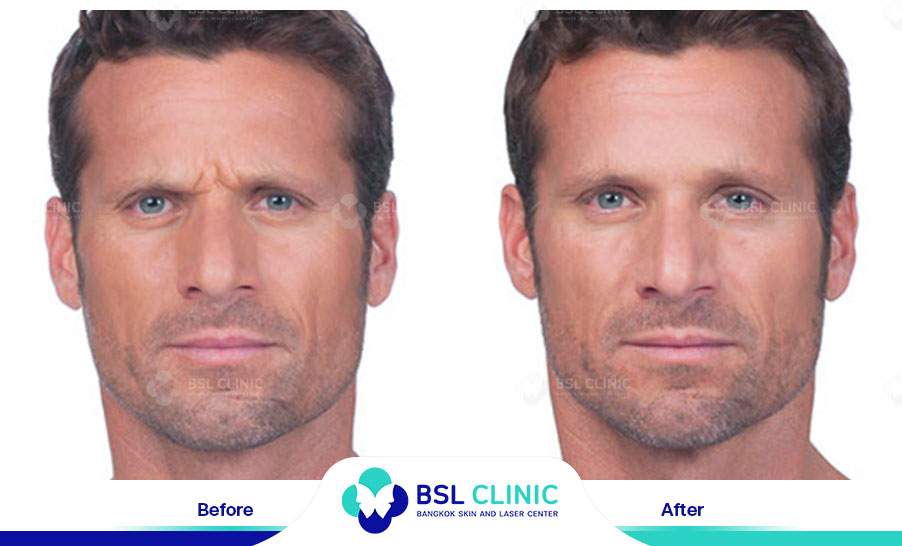 result-aniti-wrinkles