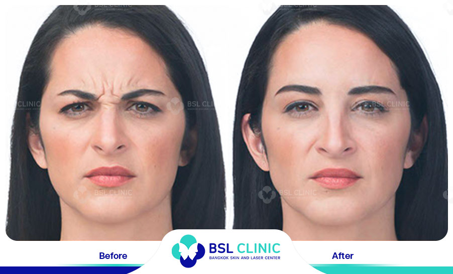 result-aniti-wrinkles