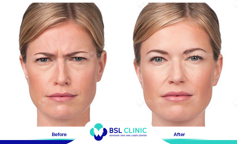 result-aniti-wrinkles