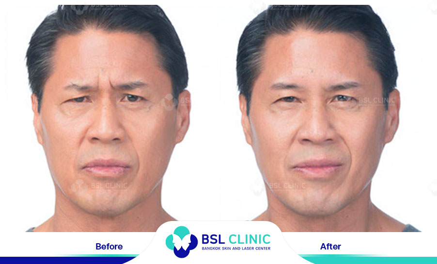 result-aniti-wrinkles