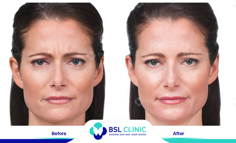 result-aniti-wrinkles