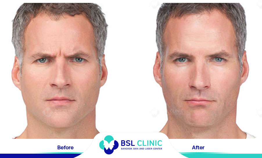 result-aniti-wrinkles