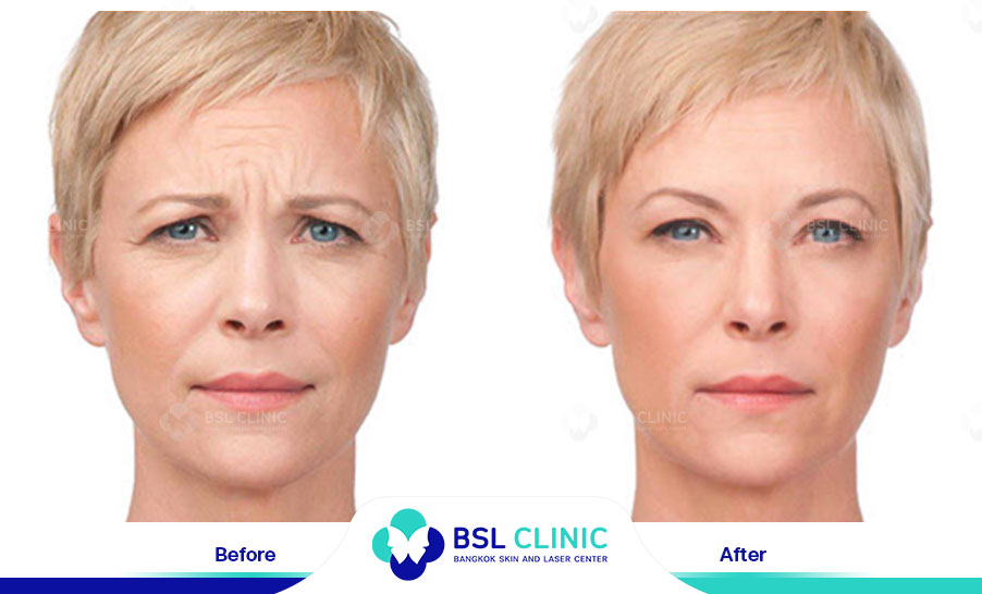 result-aniti-wrinkles