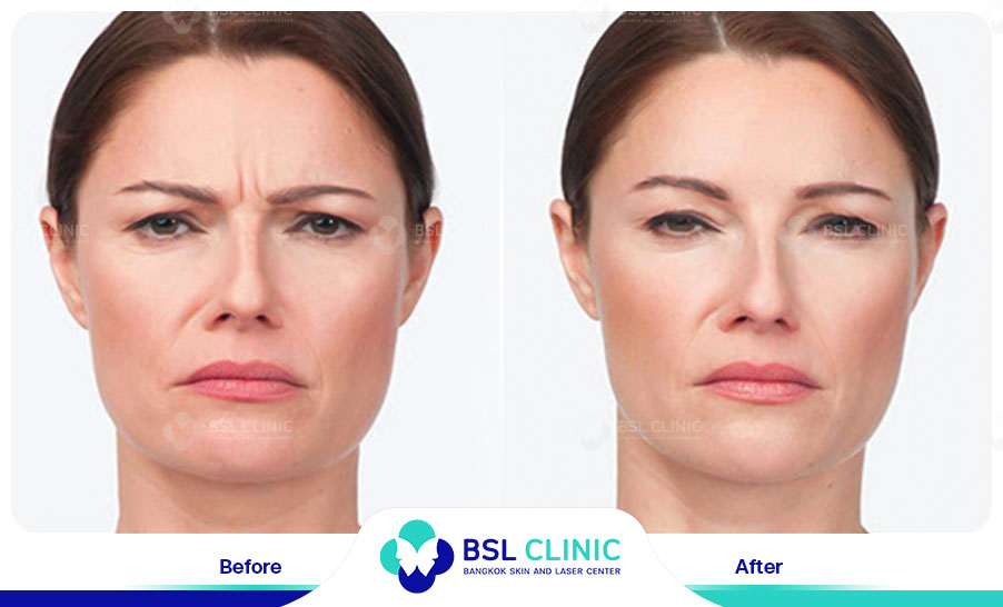 result-aniti-wrinkles