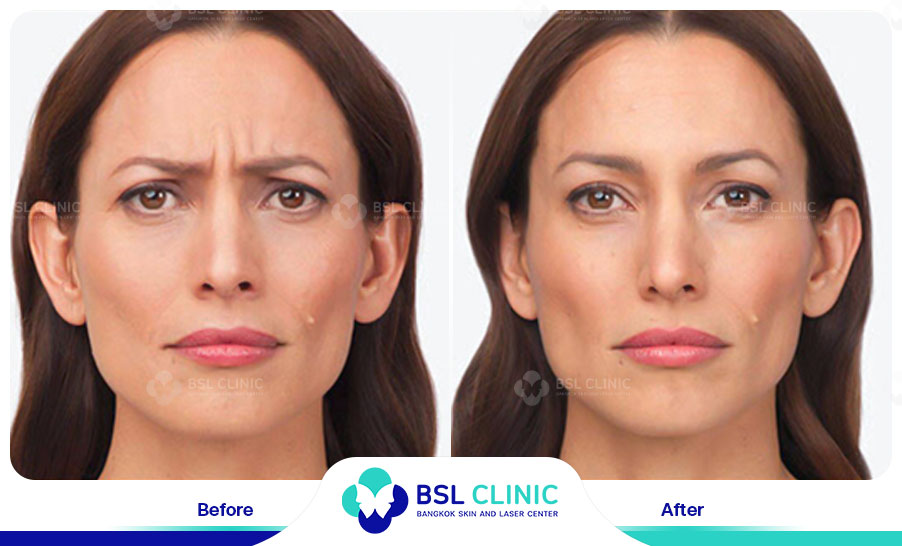 result-aniti-wrinkles