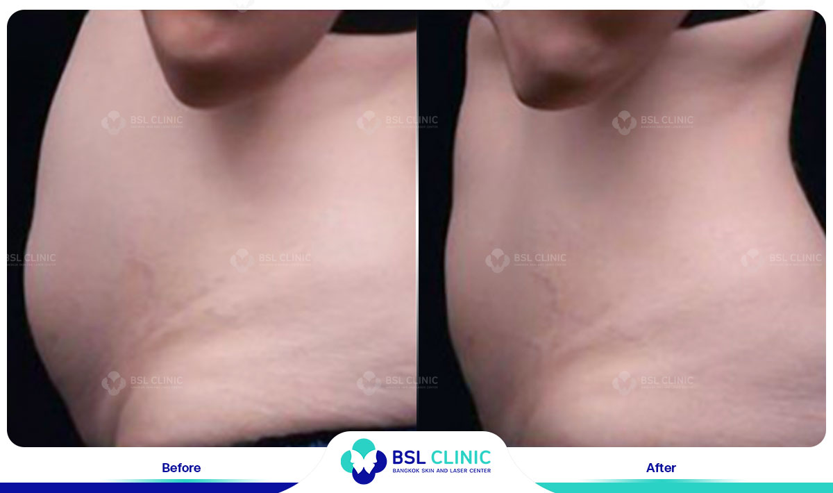 before after fat removal