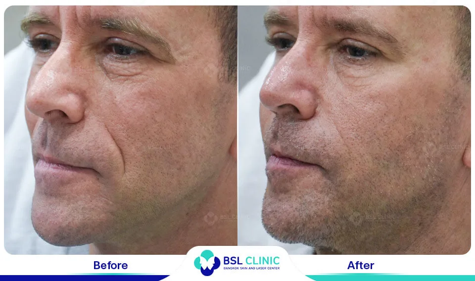 result wrinkles facelift younger