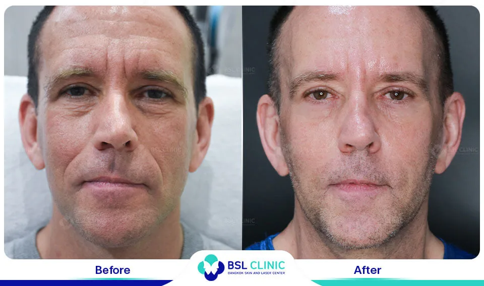 result wrinkles facelift younger