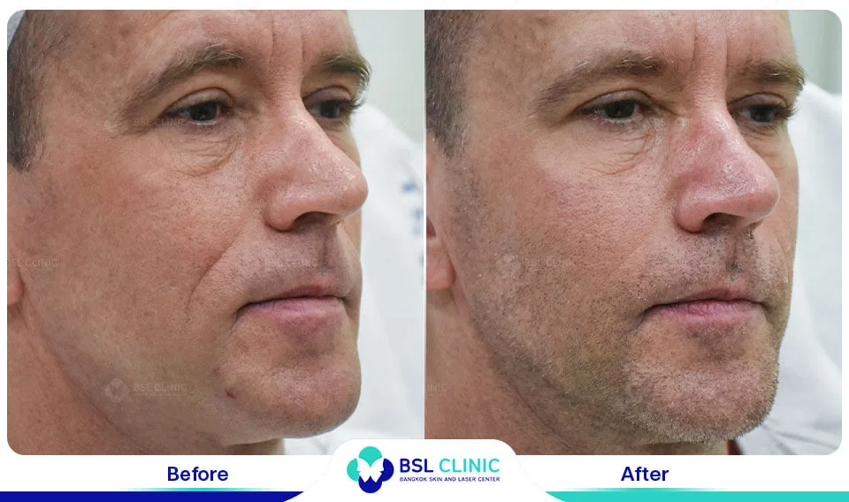 result wrinkles facelift younger