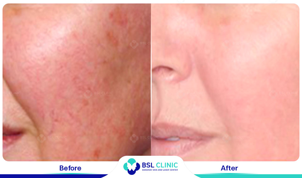 results-B&C-IPL