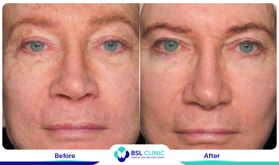 results Pigmented Laser