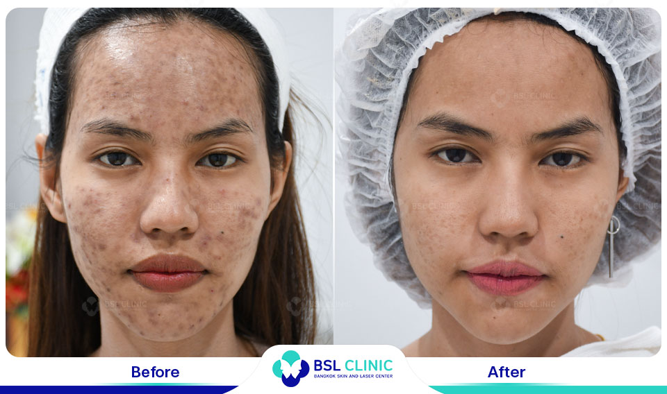 results Pigmented Laser