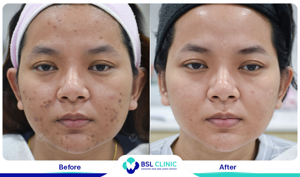 results Pigmented Laser
