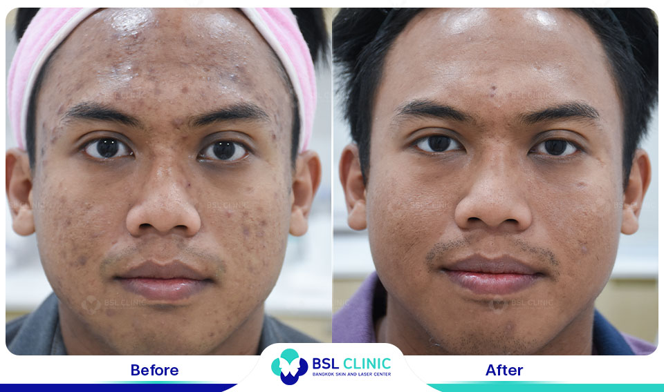 results Pigmented Laser