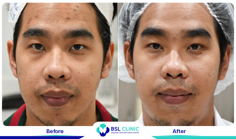 results Pigmented Laser