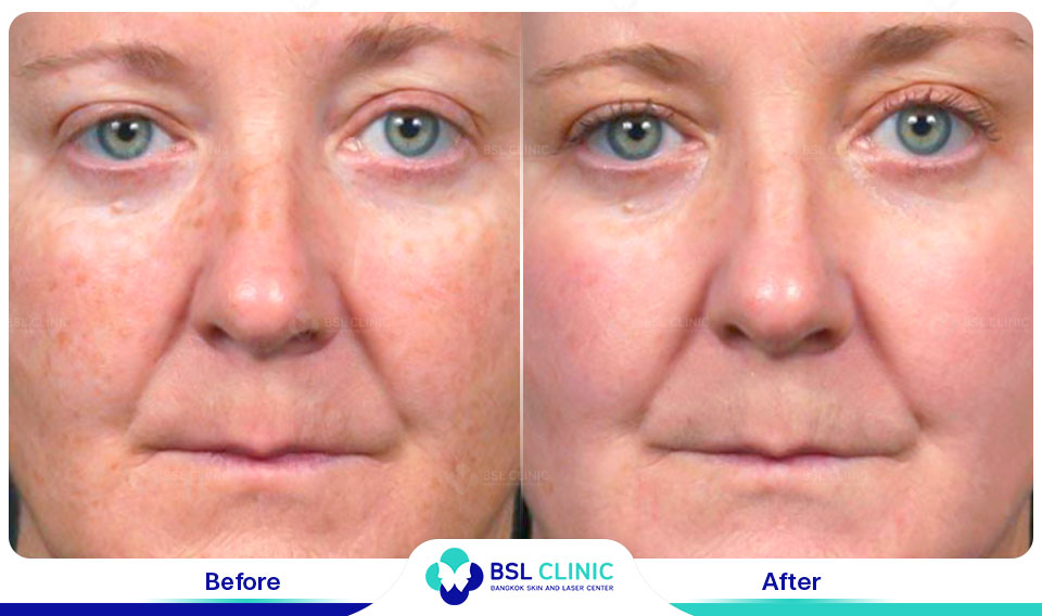 results Pigmented Laser