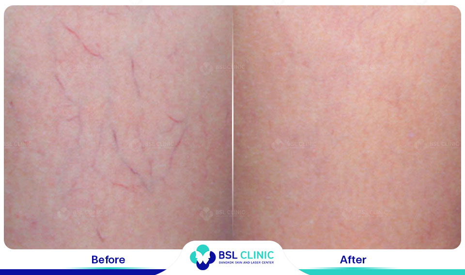 results Sclerotherapy